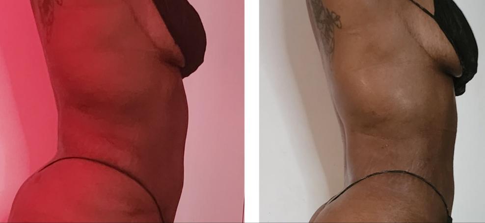 Black Ice + Metal Therapy